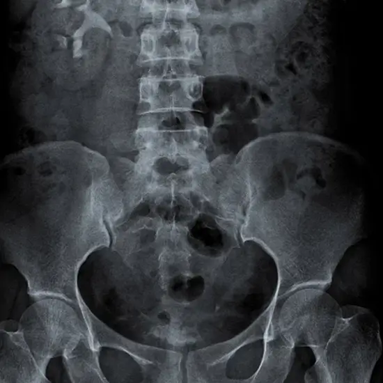 X-Ray KUB Procedure